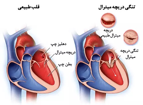 تنگی دریچه میترال