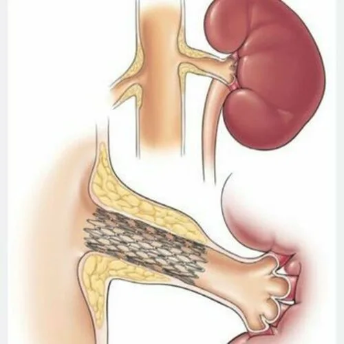 آنژیوپلاستی شریان کلیه