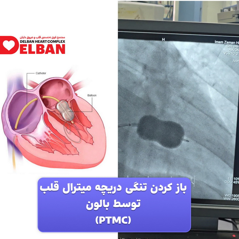 PTMC درمان تنگی دریچه‌های قلب