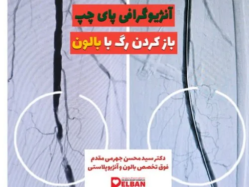 آنژیوگرافی عروق پا و فنر گذاشتن (استنت گذاری)