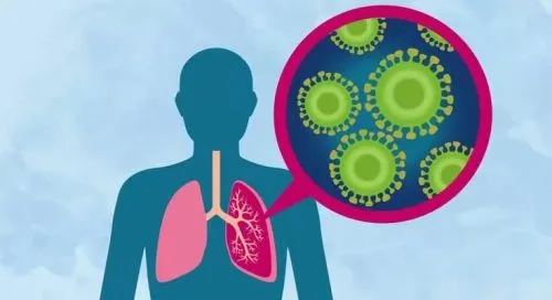 (عفونت ریه پنومونی)- Pneumonia