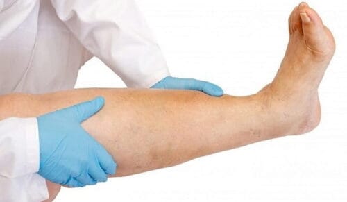 مراقبتهای پس از اسکلروتراپی