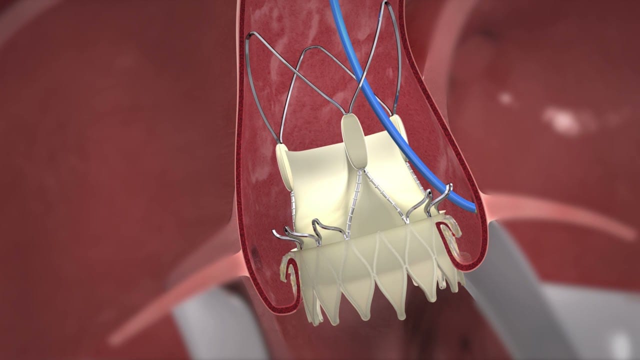 عمل TAVI یا همان تعویض دریچه آئورت