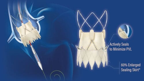 عمل TAVI یا همان تعویض دریچه آئورت